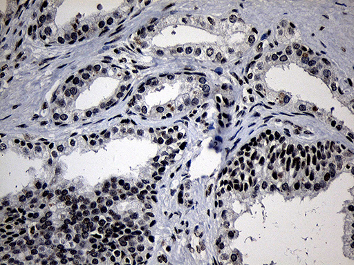 ELL / MEN Antibody - Immunohistochemical staining of paraffin-embedded Carcinoma of Human prostate tissue using anti-ELL mouse monoclonal antibody. (Heat-induced epitope retrieval by 1mM EDTA in 10mM Tris buffer. (pH8.5) at 120°C for 3 min. (1:150)