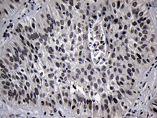 ELL / MEN Antibody - Immunohistochemical staining of paraffin-embedded Carcinoma of Human lung tissue using anti-ELL mouse monoclonal antibody. (Heat-induced epitope retrieval by 1mM EDTA in 10mM Tris buffer. (pH8.5) at 120°C for 3 min. (1:150)