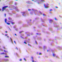 ELL / MEN Antibody - Immunohistochemical analysis of MEN staining in human breast cancer formalin fixed paraffin embedded tissue section. The section was pre-treated using heat mediated antigen retrieval with sodium citrate buffer (pH 6.0). The section was then incubated with the antibody at room temperature and detected using an HRP conjugated compact polymer system. DAB was used as the chromogen. The section was then counterstained with hematoxylin and mounted with DPX.