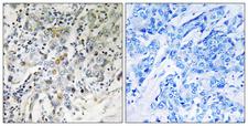 ELL2 Antibody - Immunohistochemistry analysis of paraffin-embedded human breast carcinoma tissue, using ELL2 Antibody. The picture on the right is blocked with the synthesized peptide.