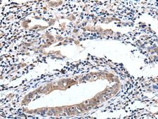 ELMO1 / ELMO 1 Antibody - Immunohistochemistry of paraffin-embedded Human cervical cancer tissue  using ELMO1 Polyclonal Antibody at dilution of 1:40(×200)