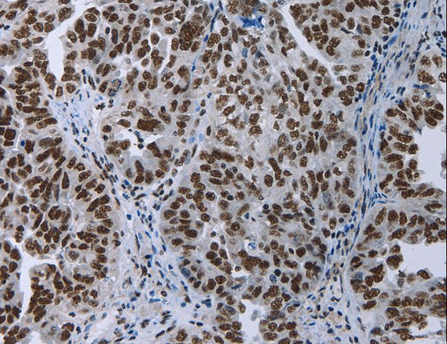 ELN / Elastin Antibody - Immunohistochemistry of paraffin-embedded Human ovarian cancer using ELN Polyclonal Antibody at dilution of 1:50.