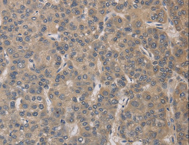 ELOVL1 Antibody - Immunohistochemistry of paraffin-embedded Human liver cancer using ELOVL1 Polyclonal Antibody at dilution of 1:30.