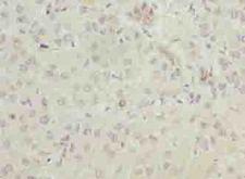 ELOVL2 Antibody - Immunohistochemistry of paraffin-embedded human liver cancer using antibody at dilution of 1:100.