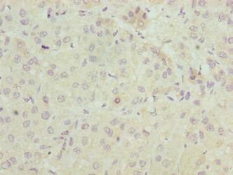 ELOVL2 Antibody - Immunohistochemistry of paraffin-embedded human liver cancer using ELOVL2 Antibody at dilution of 1:100
