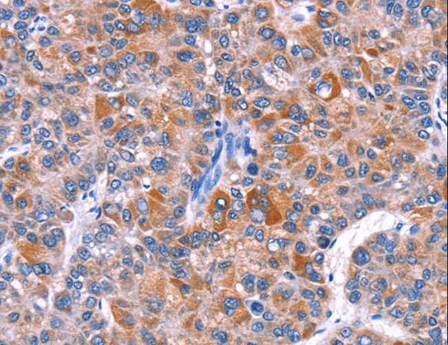 ELP2 / STATIP1 Antibody - Immunohistochemistry of paraffin-embedded Human thyroid cancer using ELP2 Polyclonal Antibody at dilution of 1:40.