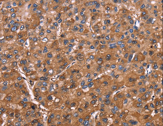 ELP2 / STATIP1 Antibody - Immunohistochemistry of paraffin-embedded Human colon cancer using ELP2 Polyclonal Antibody at dilution of 1:40.