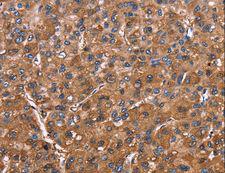 ELP2 / STATIP1 Antibody - Immunohistochemistry of paraffin-embedded Human colon cancer using ELP2 Polyclonal Antibody at dilution of 1:40.