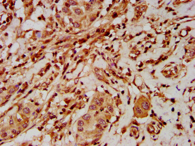 ELP2 / STATIP1 Antibody - Immunohistochemistry Dilution at 1:500 and staining in paraffin-embedded human liver cancer performed on a Leica BondTM system. After dewaxing and hydration, antigen retrieval was mediated by high pressure in a citrate buffer (pH 6.0). Section was blocked with 10% normal Goat serum 30min at RT. Then primary antibody (1% BSA) was incubated at 4°C overnight. The primary is detected by a biotinylated Secondary antibody and visualized using an HRP conjugated SP system.