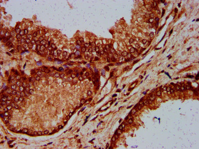 ELP4 Antibody - Immunohistochemistry Dilution at 1:600 and staining in paraffin-embedded human prostate cancer performed on a Leica BondTM system. After dewaxing and hydration, antigen retrieval was mediated by high pressure in a citrate buffer (pH 6.0). Section was blocked with 10% normal Goat serum 30min at RT. Then primary antibody (1% BSA) was incubated at 4°C overnight. The primary is detected by a biotinylated Secondary antibody and visualized using an HRP conjugated SP system.