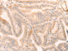 ELP4 Antibody - Immunohistochemistry of paraffin-embedded Human thyroid cancer tissue  using ELP4 Polyclonal Antibody at dilution of 1:25(×200)