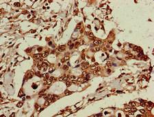 ELP6 Antibody - Immunohistochemistry of paraffin-embedded human pancreatic cancer at dilution of 1:100