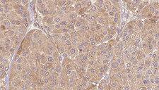 ELSPBP1 / HE12 Antibody - 1:100 staining human Melanoma tissue by IHC-P. The sample was formaldehyde fixed and a heat mediated antigen retrieval step in citrate buffer was performed. The sample was then blocked and incubated with the antibody for 1.5 hours at 22°C. An HRP conjugated goat anti-rabbit antibody was used as the secondary.