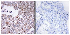 EMA / MUC1 Antibody - IHC of paraffin-embedded human breast carcinoma tissue, using MUC1 Antibody. The sample on the right was incubated with synthetic peptide.