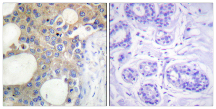 EMA / MUC1 Antibody - Immunohistochemistry analysis of paraffin-embedded human breast carcinoma tissue, using CD227/MUC1 Antibody. The picture on the right is blocked with the synthesized peptide.