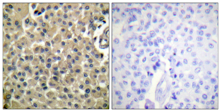 EMA / MUC1 Antibody - Immunohistochemistry analysis of paraffin-embedded human breast carcinoma tissue, using CD227/Mucin 1 Antibody. The picture on the right is blocked with the synthesized peptide.