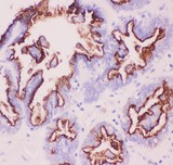 EMA / MUC1 Antibody - MUC1 antibody IHC-paraffin: Human Ovary Cancer Tissue.