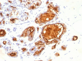 EMA / MUC1 Antibody - IHC testing of FFPE human breast carcinoma with MUC1 antibody (clone 115D8). HIER: requires steaming of sections in 10mM citrate buffer, pH 6, for 10-20 min.
