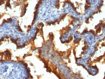 EMA / MUC1 Antibody - Formalin-fixed, paraffin-embedded human lung cancer stained with MUC1 antibody (139H2).  This image was taken for the unmodified form of this product. Other forms have not been tested.