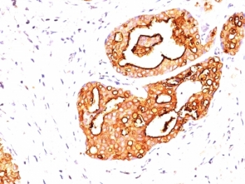 EMA / MUC1 Antibody - Formalin-fixed, paraffin-embedded human breast cancer stained with MUC1 antibody (139H2).  This image was taken for the unmodified form of this product. Other forms have not been tested.