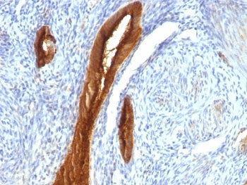 EMA / MUC1 Antibody - Formalin-fixed, paraffin-embedded human endometrial carcinoma stained with MUC1 antibody (139H2).  This image was taken for the unmodified form of this product. Other forms have not been tested.