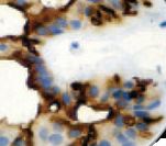 EMA / MUC1 Antibody - IHC of EÌÁ on FFPE Breast tissue.