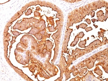 EMA / MUC1 Antibody - Formalin-fixed, paraffin-embedded human breast carcinoma stained with MUC-1 antibody (E29).  This image was taken for the unmodified form of this product. Other forms have not been tested.