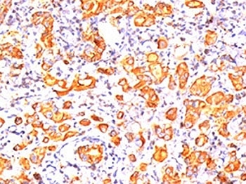 EMA / MUC1 Antibody - MUC1 antibody GP1.4 immunohistochemistry breast cancer This image was taken for the unmodified form of this product. Other forms have not been tested.