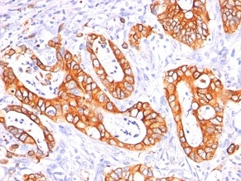 EMA / MUC1 Antibody - Formalin-fixed, paraffin-embedded human colon carcinoma stained with MUC-1 / EMA antibody (GP1.4 + E29).  This image was taken for the unmodified form of this product. Other forms have not been tested.