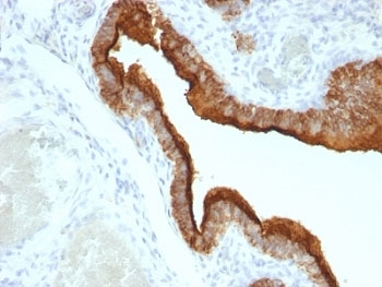 EMA / MUC1 Antibody - Formalin-fixed, paraffin-embedded human ovarian carcinoma stained with MUC-1 antibody (HMPV).  This image was taken for the unmodified form of this product. Other forms have not been tested.