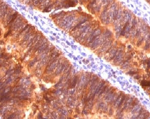 EMA / MUC1 Antibody - IHC testing of FFPE colon carcinoma and MUC-1 antibody (clone MCN01-1).  This image was taken for the unmodified form of this product. Other forms have not been tested.