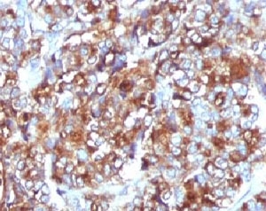 EMA / MUC1 Antibody - IHC testing of FFPE breast carcinoma and MUC-1 antibody (clone MCN01-1).  This image was taken for the unmodified form of this product. Other forms have not been tested.