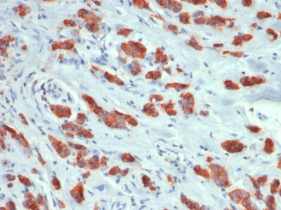 EMA / MUC1 Antibody - Formalin-fixed, paraffin-embedded human Breast Carcinoma stained with MUC1 Rabbit Recombinant Monoclonal Antibody (MUC1/1887R).