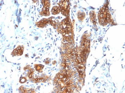 EMA / MUC1 Antibody - Formalin-fixed, paraffin-embedded human Breast Carcinoma stained with MUC1 Rabbit Recombinant Monoclonal Antibody (MUC1/2278R).
