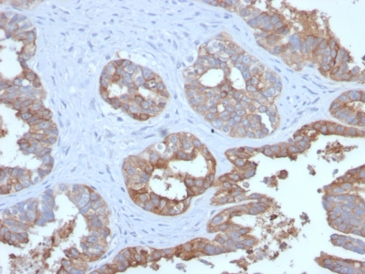 EMA / MUC1 Antibody - Formalin-fixed, paraffin-embedded human Prostate Carcinoma stained with MUC1 Recombinant Rabbit Monoclonal Antibody (MUC1/2729R).