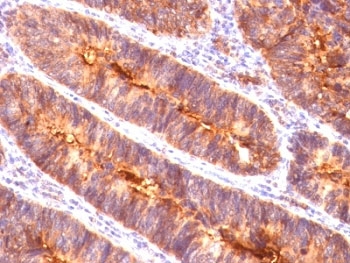 EMA / MUC1 Antibody - Formalin-fixed, paraffin-embedded human colon carcinoma stained with EMA antibody (MUC1/845).  This image was taken for the unmodified form of this product. Other forms have not been tested.