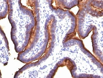 EMA / MUC1 Antibody - Formalin-fixed, paraffin-embedded human ovarian carcinoma stained with EMA antibody (MUC1/845).  This image was taken for the unmodified form of this product. Other forms have not been tested.