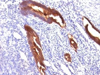 EMA / MUC1 Antibody - Formalin-fixed, paraffin-embedded human endometrial carcinoma stained with EMA antibody (MUC1/845).  This image was taken for the unmodified form of this product. Other forms have not been tested.
