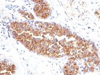 EMA / MUC1 Antibody - Formalin-fixed, paraffin-embedded human breast carcinoma stained with MUC1 / EMA antibody (MUC1/845).  This image was taken for the unmodified form of this product. Other forms have not been tested.