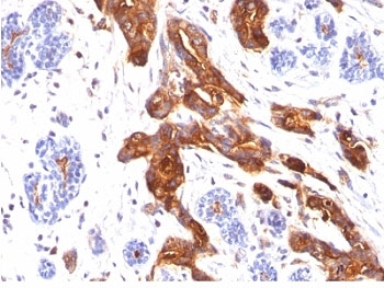 EMA / MUC1 Antibody - Formalin-fixed, paraffin-embedded human breast carcinoma stained with EMA antibody (MUC1/845).  This image was taken for the unmodified form of this product. Other forms have not been tested.