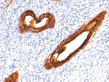 EMA / MUC1 Antibody - Formalin-fixed, paraffin-embedded human endometrial carcinoma stained with MUC-1 antibody (MUC1/520).  This image was taken for the unmodified form of this product. Other forms have not been tested.