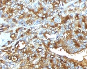 EMA / MUC1 Antibody - Formalin-fixed, paraffin-embedded human breast carcinoma stained with MUC-1 antibody (MUC1/520).  This image was taken for the unmodified form of this product. Other forms have not been tested.