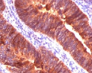 EMA / MUC1 Antibody - Formalin-fixed, paraffin-embedded human colon carcinoma stained with MUC-1 antibody (MUC1/520).  This image was taken for the unmodified form of this product. Other forms have not been tested.