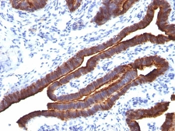 EMA / MUC1 Antibody - Formalin-fixed, paraffin-embedded human ovarian carcinoma stained with MUC-1 antibody (MUC1/520).  This image was taken for the unmodified form of this product. Other forms have not been tested.