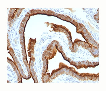 EMA / MUC1 Antibody - Epithelial Marker Antigen antibody immunohistochemistry breast cancer, clone MUC1/967.  This image was taken for the unmodified form of this product. Other forms have not been tested.