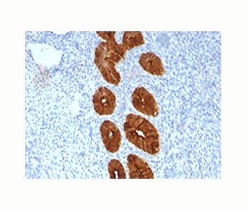 EMA / MUC1 Antibody - Epithelial Marker Antigen antibody immunohistochemistry endometrial cancer, clone MUC1/967.  This image was taken for the unmodified form of this product. Other forms have not been tested.