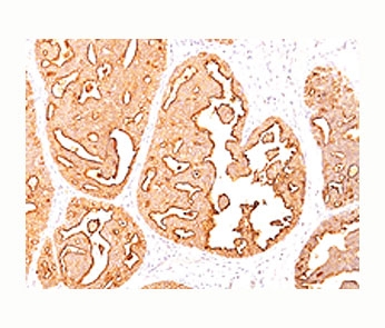 EMA / MUC1 Antibody - Epithelial Marker Antigen antibody immunohistochemistry breast cancer, clone MUC1/967.  This image was taken for the unmodified form of this product. Other forms have not been tested.