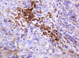 EMA / MUC1 Antibody - IHC of paraffin-embedded Adenocarcinoma of Human colon tissue using anti-MUC1 mouse monoclonal antibody.