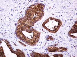 EMA / MUC1 Antibody - IHC of paraffin-embedded Human prostate tissue using anti-MUC1 mouse monoclonal antibody.