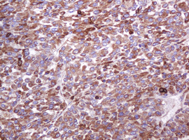 EMA / MUC1 Antibody - IHC of paraffin-embedded Carcinoma of Human liver tissue using anti-MUC1 mouse monoclonal antibody.